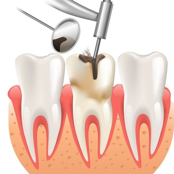 endodonti